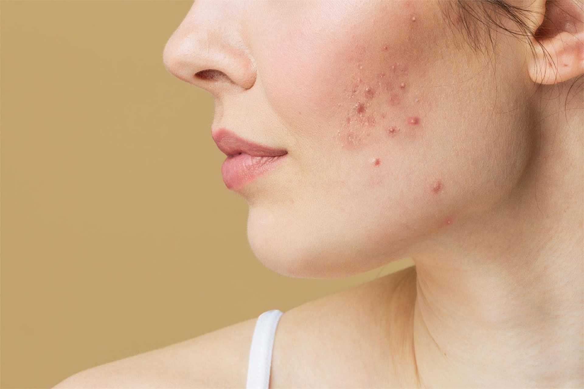 Avances revolucionarios en tratamientos para el acné